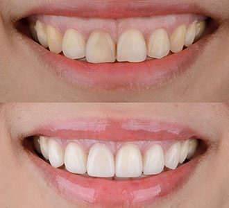 Gummy Smile (Diş Eti Estetiği) Botoks